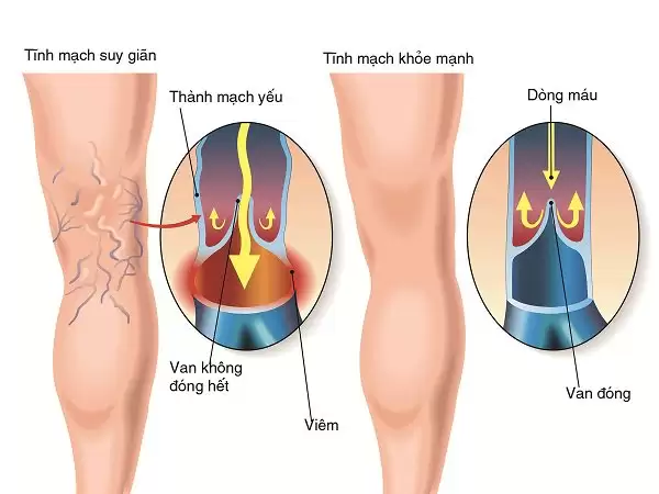 Ứng dụng đông y chữa suy giãn tĩnh mạch chân