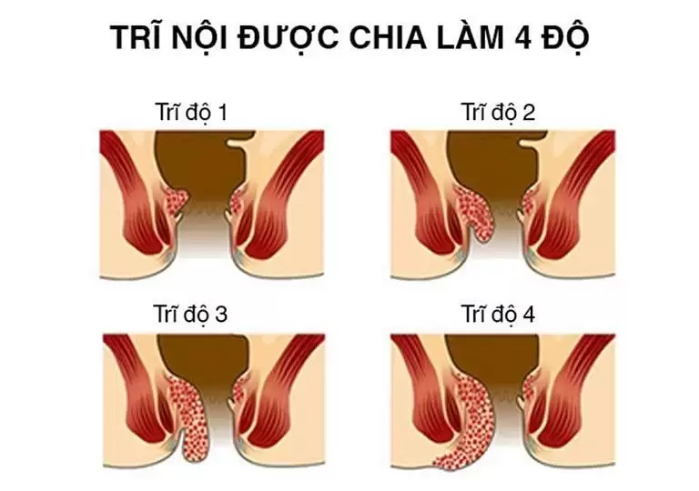 thuốc đông y chữa bệnh trĩ